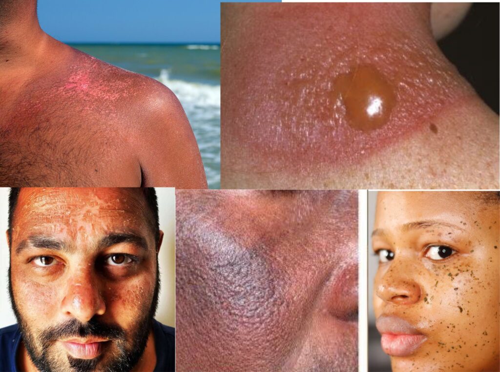 symptoms of sunbrun